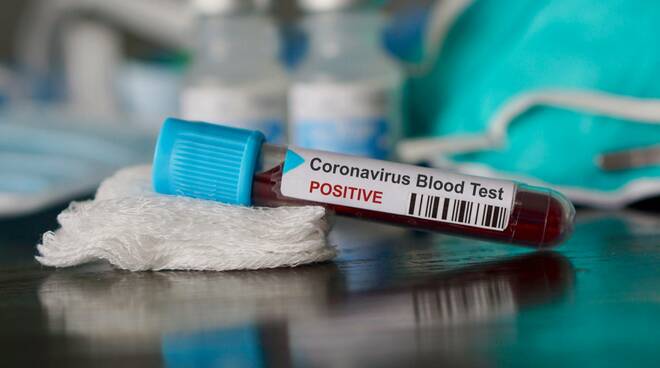 Covid - coronavirus - positivo 