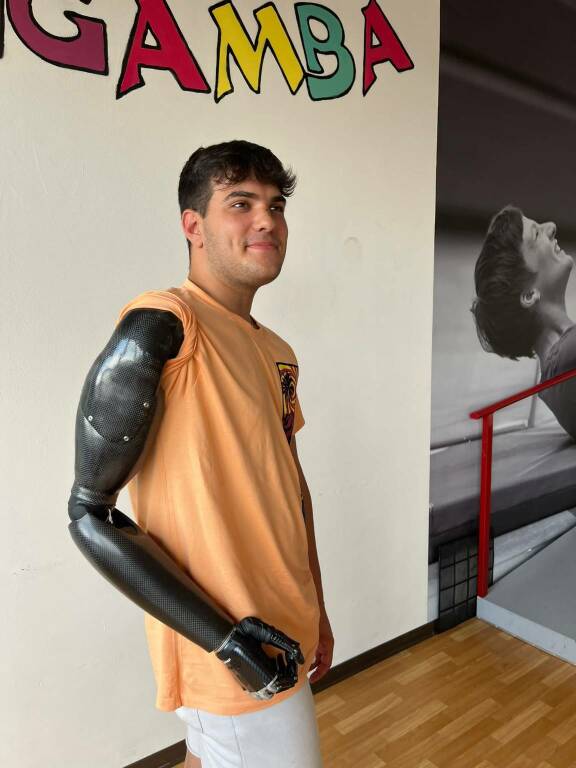 He loses his arm in an accident, but at the Maria Cecilia Hospital in Cotignola he receives a bionic one.  David's story: 